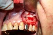 chronic_granulomatous_periodontitis_08-4626794