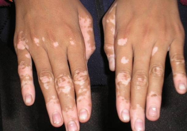 manos-con-manchas-de-vitiligo-610x430-7551066